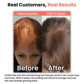 heyrestore-professional-hair-regrowth-laser-comb-back-to-full-and-strong-hair-before-after-emillia