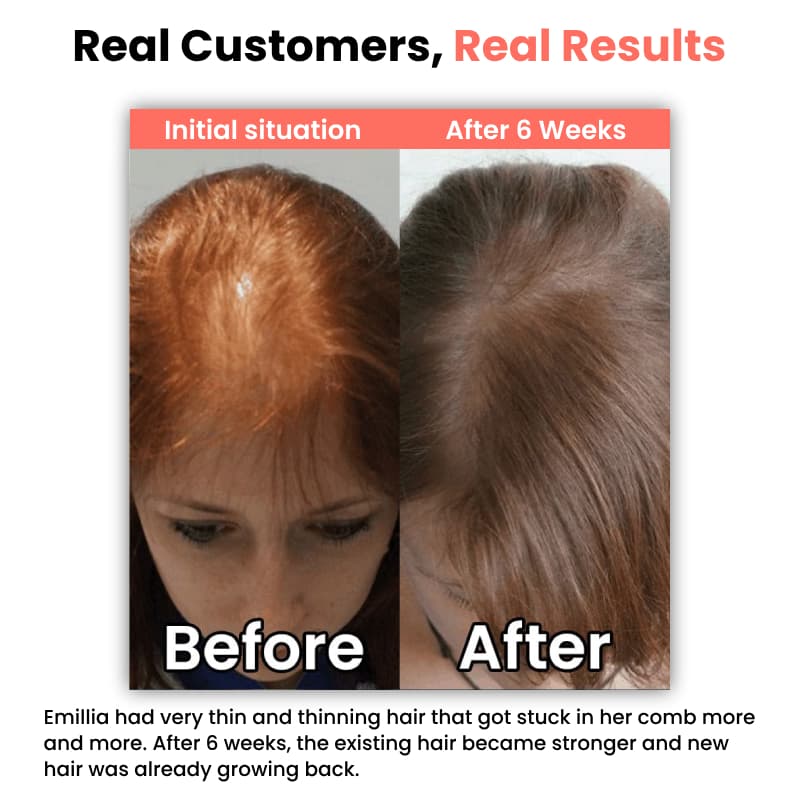 heyrestore-professional-hair-regrowth-laser-comb-back-to-full-and-strong-hair-before-after-emillia