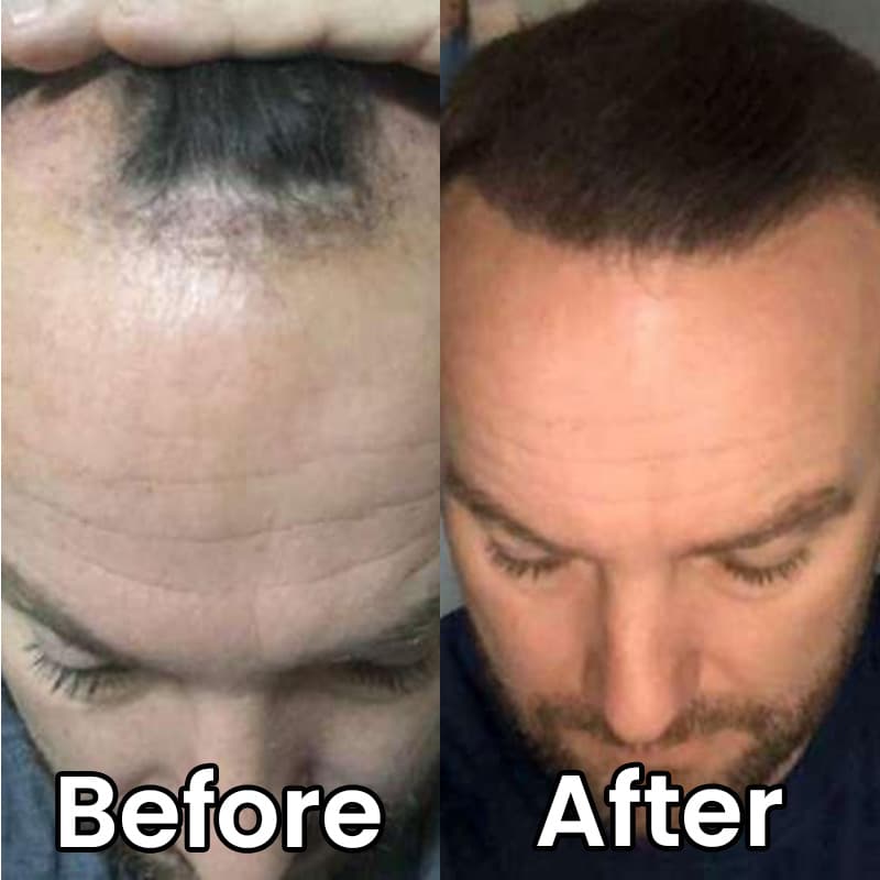 heyrestore-professional-hair-regrowth-laser-comb-back-to-full-and-strong-hair-before-after-man