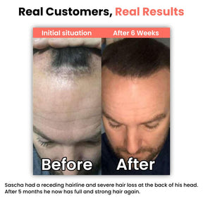 heyrestore-professional-hair-regrowth-laser-comb-back-to-full-and-strong-hair-before-after-sascha